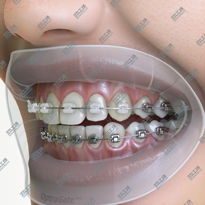 images/goods_img/202104091/Orthodontic Mouth/3.jpg
